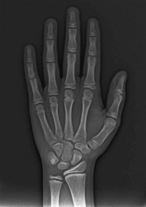 Cureus Age Estimation By Dental Calcification Stages And Hand Wrist