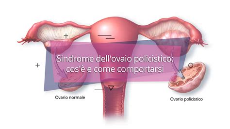 Sindrome dell ovaio policistico cos è e come comportarsi