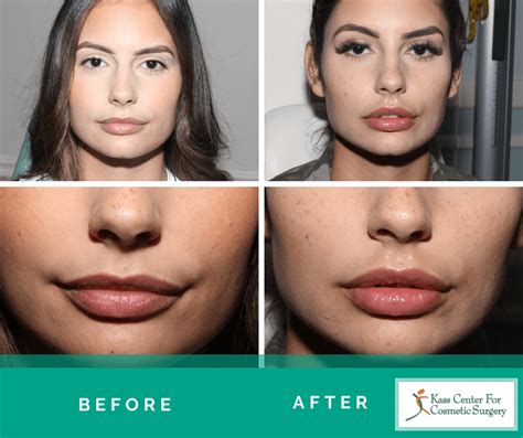 Lip Augmentation And Injections St Petersburg And Clearwater Kass