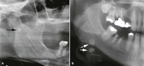 A stone (calculus) in a salivary gland or duct, most often the duct of the submandibular gland. 29. Salivary Gland Diseases | Pocket Dentistry