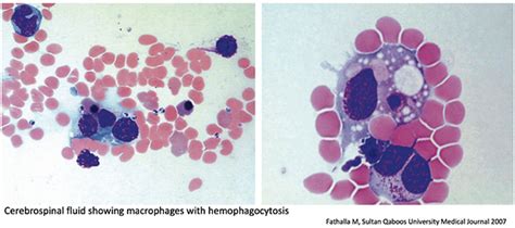 Hemophagocytic Lymphohistiocytosis Hlh Emcrit Project