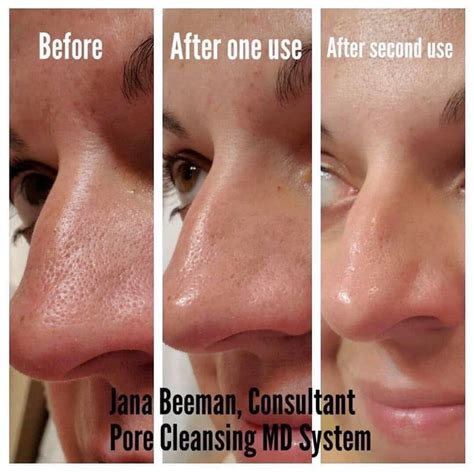 Blackhead Remover And Pore Cleansing System Rodan Fields® Pore
