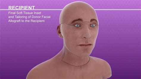Video How Surgeons Performed 26 Year Old Mans Face Transplant