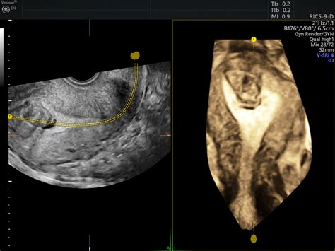 Ultrasound Fibroids Empowered Womens Health