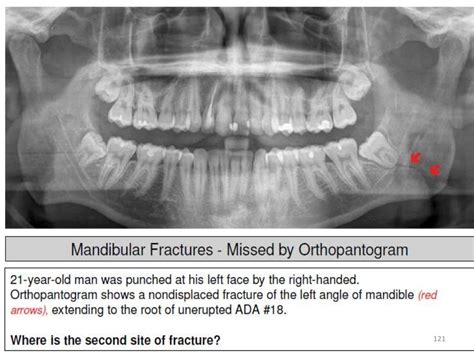 Conventional Radiography In Maxillofacial Trauma