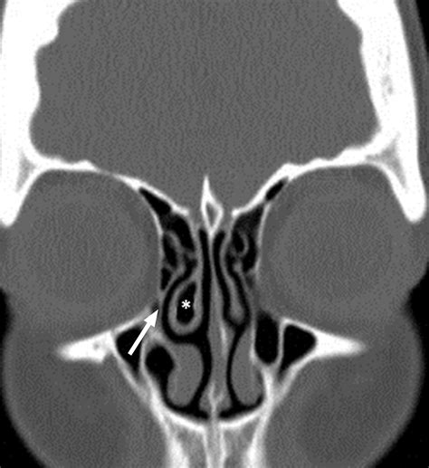 The Preoperative Sinus Ct Avoiding A “close” Call With Surgical