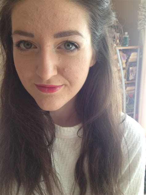 My Acne Story How Roaccutane Changed My Life Orlagh Claire