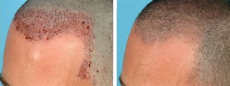 How To Clean And Remove Scab After Hair Transplant Surgery Hair