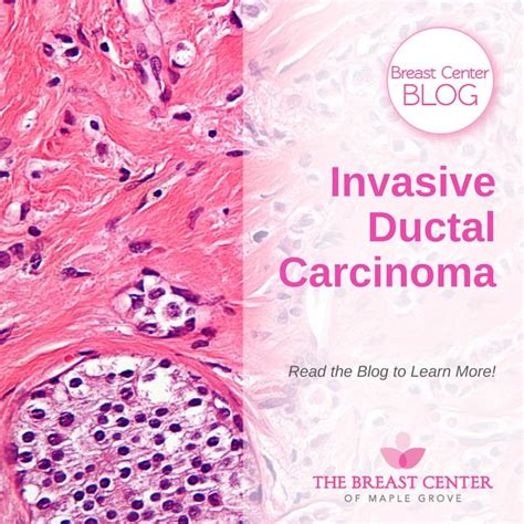 Invasive Ductal Carcinoma Breast Center Of Maple Grove