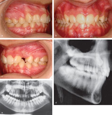 21 Impacted Teeth And Their Orthodontic Management Pocket Dentistry