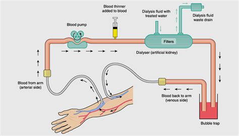 Different Types Of Dialysis