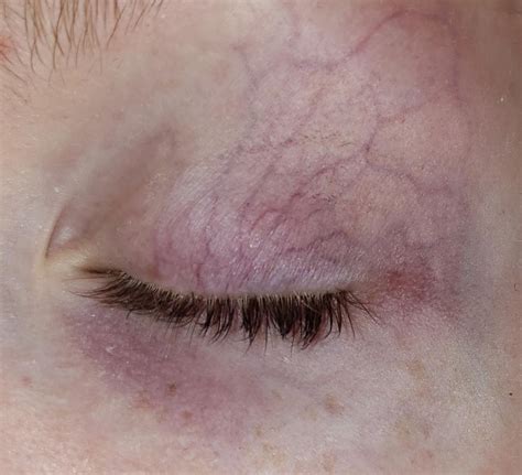 Red Veins On Eyelids Most Popular Causes Prevention And More