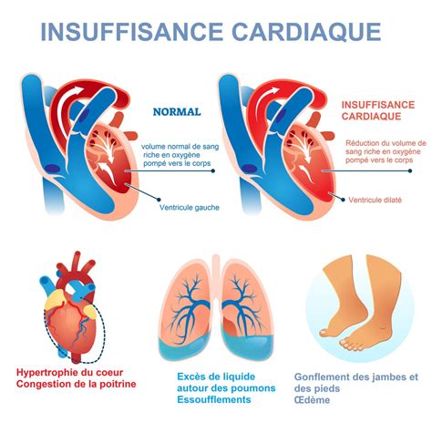 Insuffisance Cardiaque Symptômes Traitement Ventre Gonflé