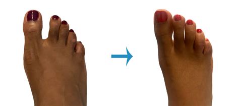 Before And After Foot Surgery Image Gallery London Foot And Ankle Surgery