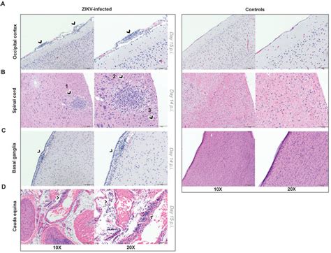 Neurohistopathology Of Postnatal Zikv Infection In Infant Rms