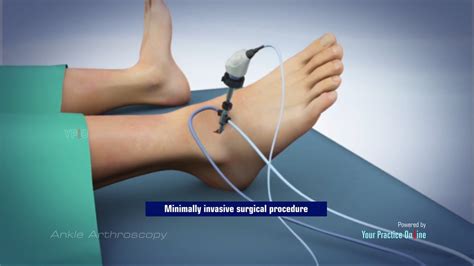 Ankle Reconstruction Surgery Lateral Ankle Ligament Reconstruction