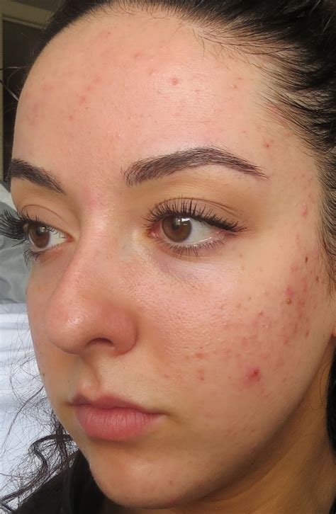 My Skins Journey Week 21 Banish Acne Scars