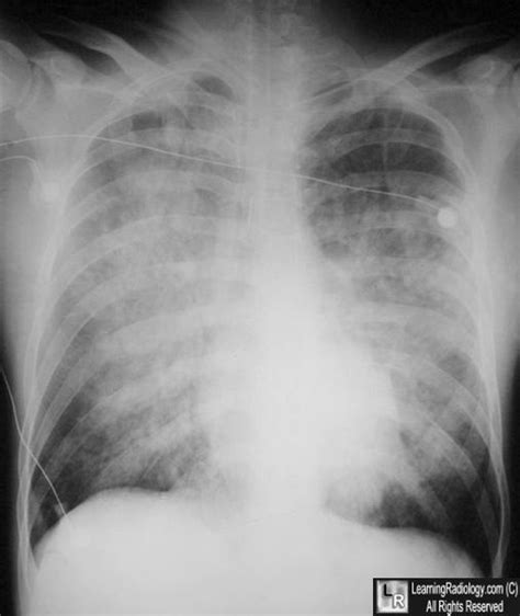 When the heart is enlarged it is sometimes possible to determine if a specific heart chamber is enlarged. Learning Radiology - Congestive Heart Failure, Pulmonary Edema