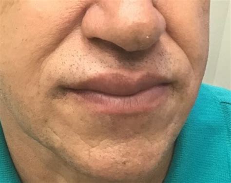 Swelling Upper Lip Angioedema