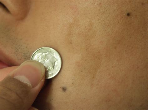 Explainer What Are Birthmarks And Why Do We Get Them