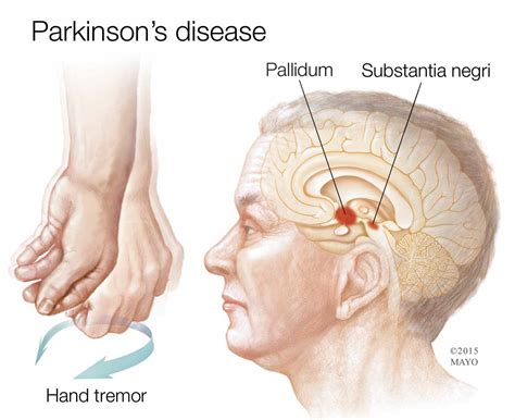 Mayo Clinic Q And A Rate Of Progression Of Parkinsons Disease Hard To