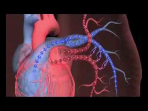L'embolia polmonare rappresenta la terza causa di patologia cardiovascolare dopo l'infarto miocardico e l'ictus statisticamente i soggetti maggiormente colpiti da embolia polmonare sono le donne. embolia polmonare, pulmonary embolism - YouTube