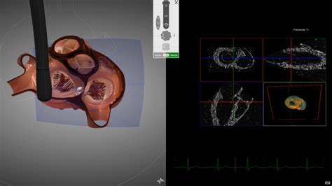3d Echo Comes To Heartworks Intelligent Ultrasound