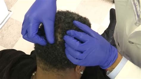 Why Black Women Specifically Can Lose Their Hair Due To This Disease