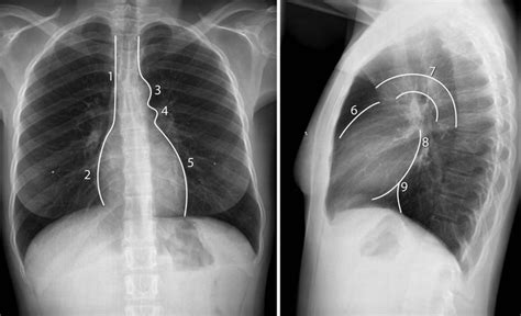 Cardiac Anatomy And Imaging Techniques Radiology Key