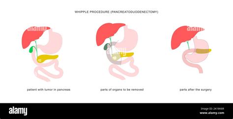 Infografía Médica De Procedimiento Whipple Pancreaticoduodenectomía
