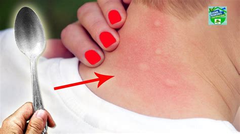 8 Genius Ways To Heal Mosquito Bites Fast Youtube