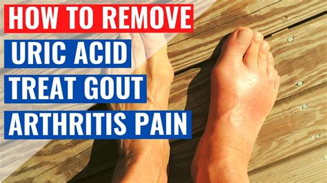 How To Remove Uric Acid In Joints And Treat Gout And Arthritis Pain