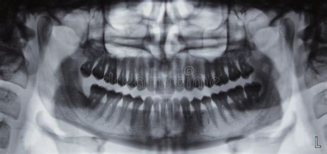 Panoramic Dental X Ray 32 Teeth 4 Wisdom Stock Photo Image Of