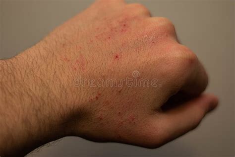 Skin Rashes That Itch Only On Hand Telereti