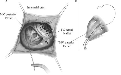 Right Axillary Thoracotomy For Transatrial Repair Of Congenital Heart Defects Vsd Partial Av