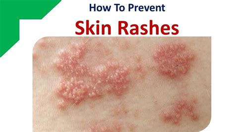 How To Prevent Skin Rashes With Home Remedies Youtube