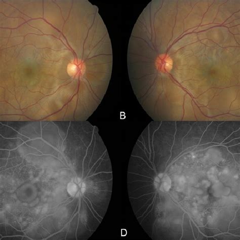 Fundus Photographs Of The Right Eye A And Left Eye B Fluorescein