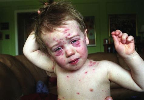 How Much Does The Chickenpox Vaccine Cost Where Can You Buy It