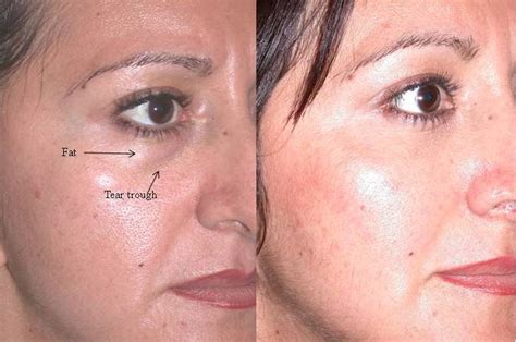 Lower Eyelid Blepahroplasty With Fat Transfer Repositioning Or