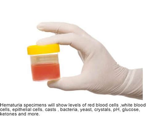 In males, blood in the urine can result from any of the following: 44 best images about Blood In Urine (Hematuria) on ...