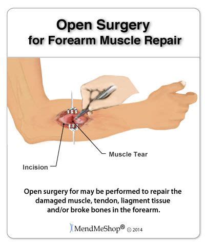 Open surgery repair for torn forearm muscle and soft tissue. | Forearm muscles, Muscle tear, Muscle