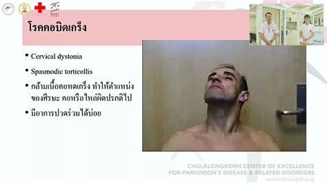 โรคคอบิดเกร็ง Cervical Dystonia เนื้อหาที่ปรับปรุงใหม่เกี่ยวกับ