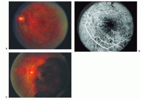 Pathology Of The Retina Ento Key