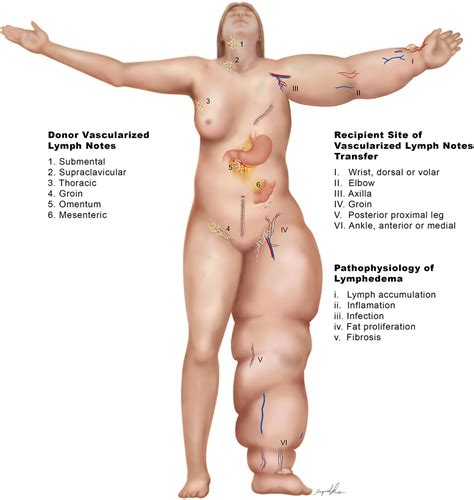 Vascularized Lymph Node Flap Transfer VLNT Surgery Ming Huei Cheng MD