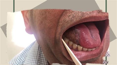a case of tongue cancer operated in alzahra cancer center with tongue excision and