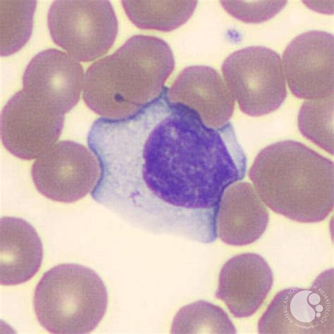 Typically, they can be more than 30 μm in diameter with varying size and shape. Reactive lymphocyte