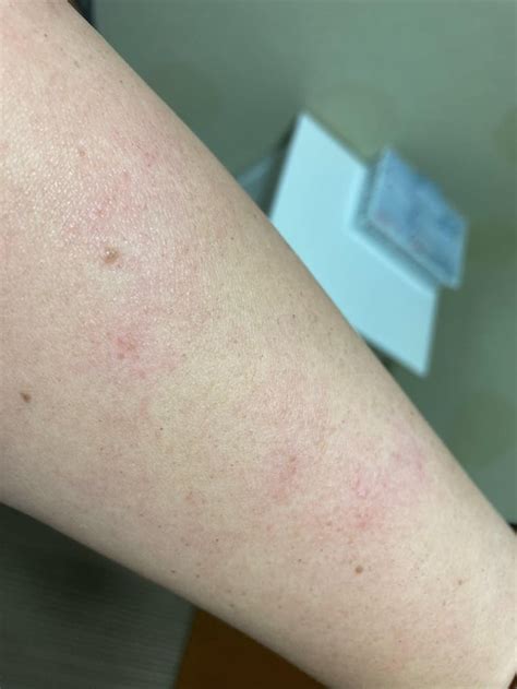 Extremely Itchy Bilateral Forearm Rash See Comments R