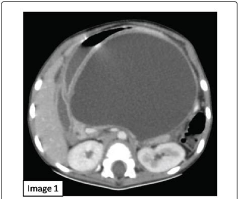 Axial Contrast Enhanced Ct Images Of Abdomen Showing A Large Thin