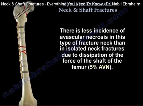 Ipsilateral synonyms, ipsilateral pronunciation, ipsilateral translation, english dictionary definition of ipsilateral. Ipsilateral femoral neck and shaft fracture ...