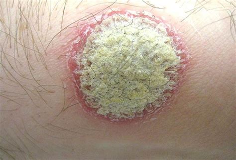 The Many Manifestations Of Psoriasis
